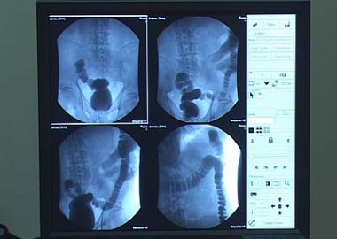 Новый Регион: В Приднестровье начали применять метод близкофокусной рентгенотерапии при лечении злокачественных опухолей (ФОТО)